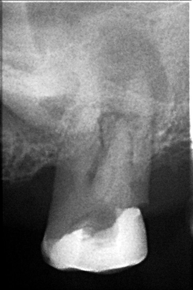 root-canal-treatment-before
